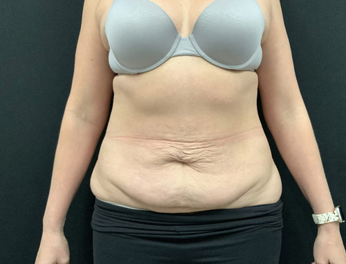 40 year old female 3.5 months after full abdominoplasty with liposuction of the upper abdomen and flanks.