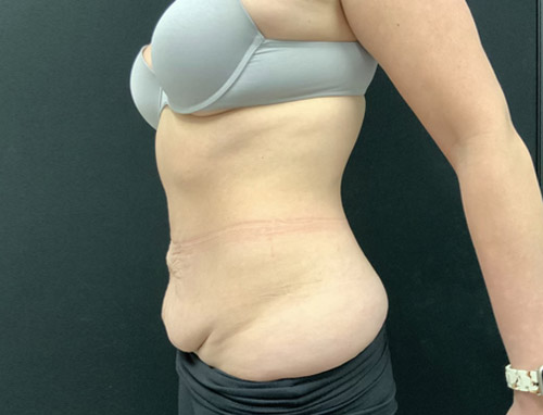 40 year old female 3.5 months after full abdominoplasty with liposuction of the upper abdomen and flanks.