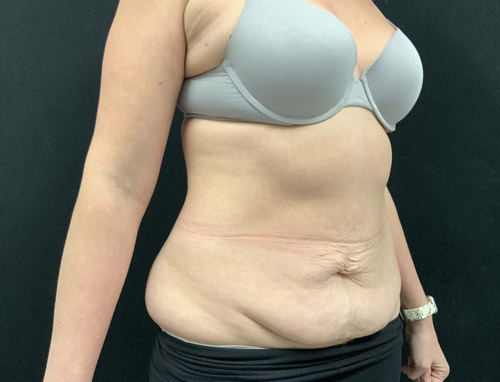 40 year old female 3.5 months after full abdominoplasty with liposuction of the upper abdomen and flanks.