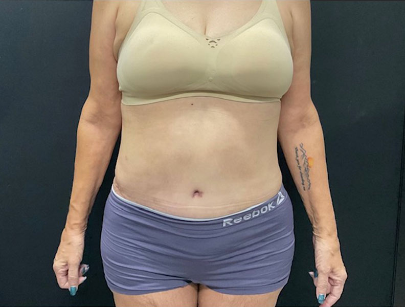 57 year old weight loss patient 3 months after extended “tummy tuck” with liposuction