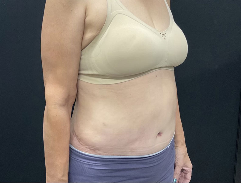 57 year old weight loss patient 3 months after extended “tummy tuck” with liposuction