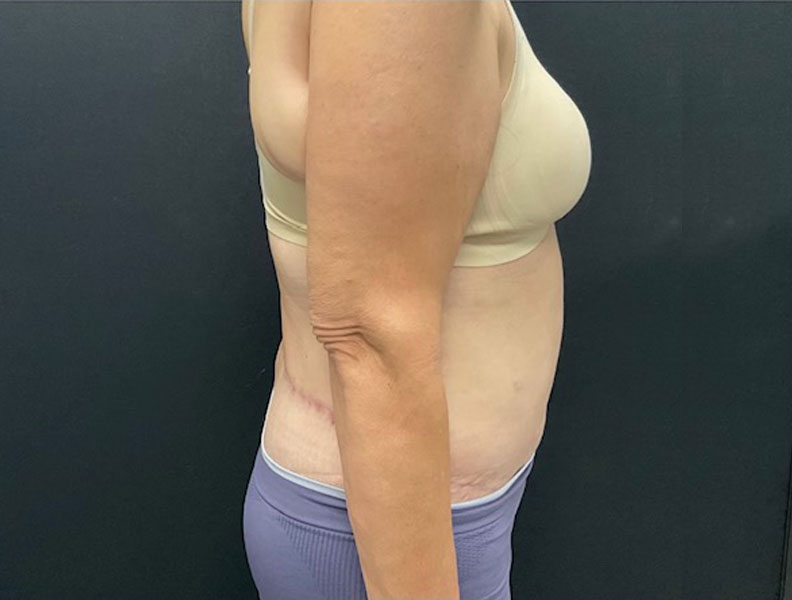 57 year old weight loss patient 3 months after extended “tummy tuck” with liposuction