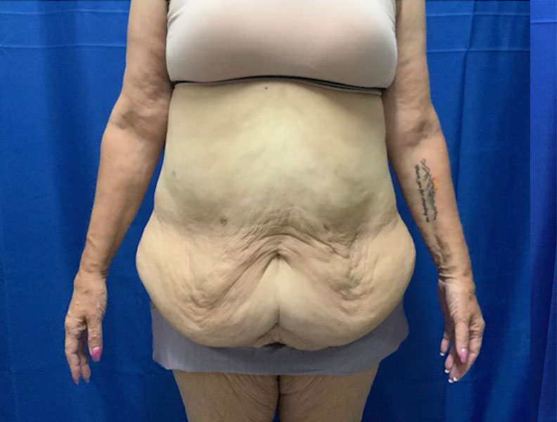 57 year old weight loss patient 3 months after extended “tummy tuck” with liposuction