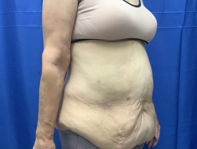 57 year old weight loss patient 3 months after extended “tummy tuck” with liposuction