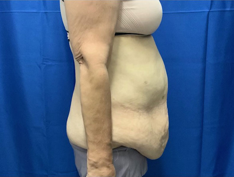 57 year old weight loss patient 3 months after extended “tummy tuck” with liposuction