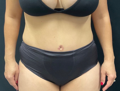44 year old female 3 months after abdominoplasty with repair of diastasis recti with Durasorb mesh