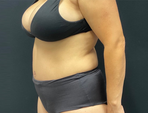 44 year old female 3 months after abdominoplasty with repair of diastasis recti with Durasorb mesh