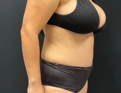 44 year old female 3 months after abdominoplasty with repair of diastasis recti with Durasorb mesh