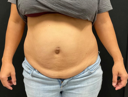 44 year old female 3 months after abdominoplasty with repair of diastasis recti with Durasorb mesh