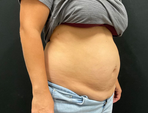 44 year old female 3 months after abdominoplasty with repair of diastasis recti with Durasorb mesh