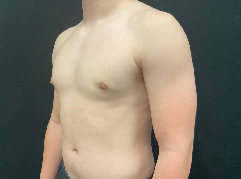 15 year old male shown 2 months after left gynecomastia excision.