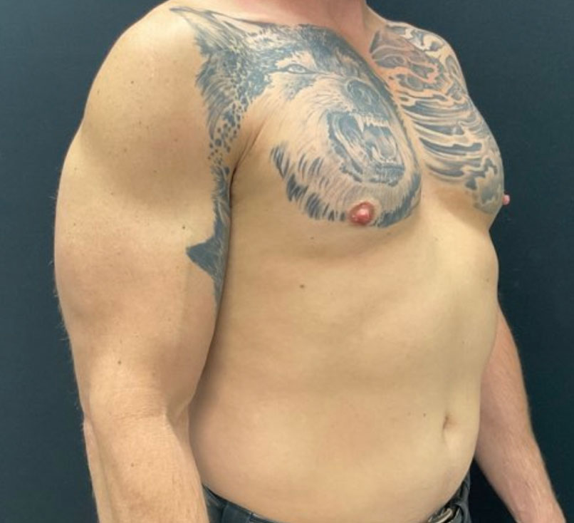 50-year-old 4 months after bilateral gynecomastia reduction