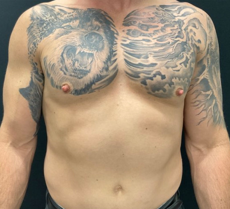 50-year-old 4 months after bilateral gynecomastia reduction