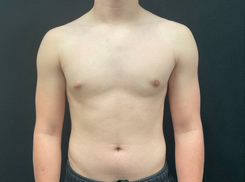 15 year old male shown 2 months after left gynecomastia excision.