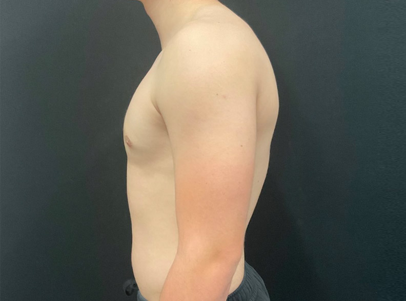 15 year old male shown 2 months after left gynecomastia excision.