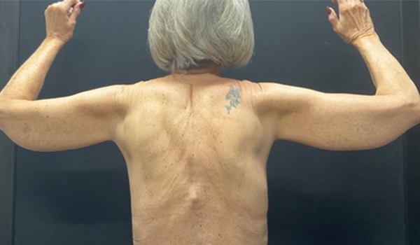 75 year old female shown 3 months after bilateral brachioplasty