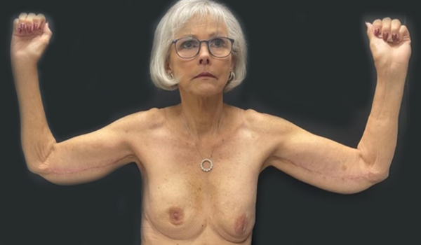 75 year old female shown 3 months after bilateral brachioplasty