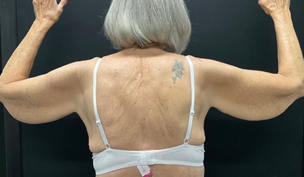 75 year old female shown 3 months after bilateral brachioplasty