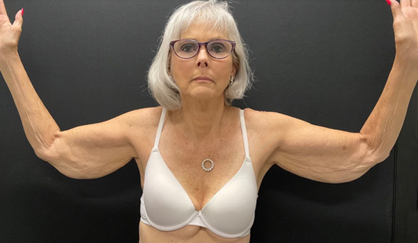 75 year old female shown 3 months after bilateral brachioplasty