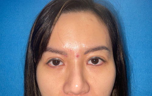 Asian Eyelid Surgery Before and After Image