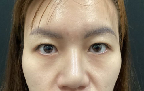 Asian Eyelid Surgery Before and After Image