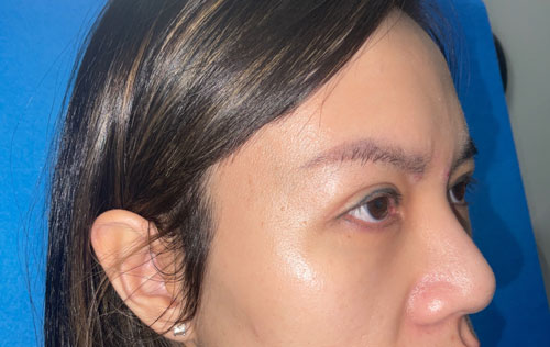 Asian Eyelid Surgery Before and After Image