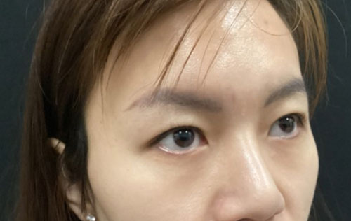 Asian Eyelid Surgery Before and After Image