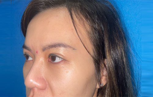 Asian Eyelid Surgery Before and After Image