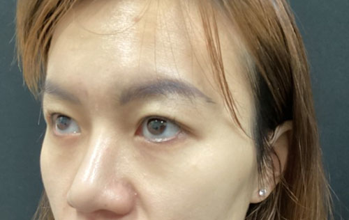 Asian Eyelid Surgery Before and After Image