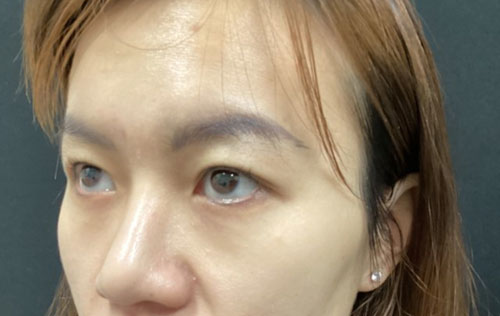 Asian Eyelid Surgery Before and After Image Asian Eyelid Surgery Before and After Image