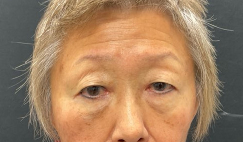 asian eyelid surgery before and after image