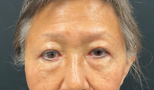 asian eyelid surgery before and after image