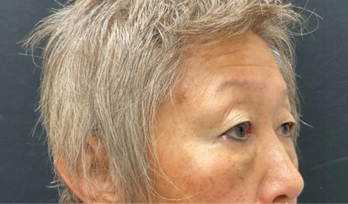 asian eyelid surgery before and after image