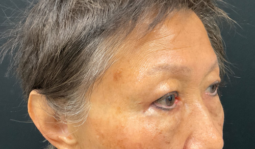 asian eyelid surgery before and after image