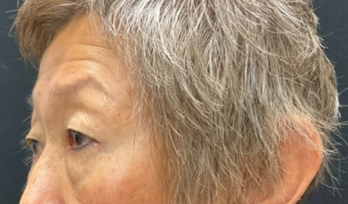 asian eyelid surgery before and after image