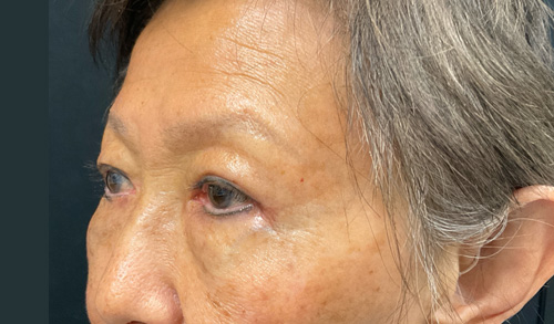 asian eyelid surgery before and after image