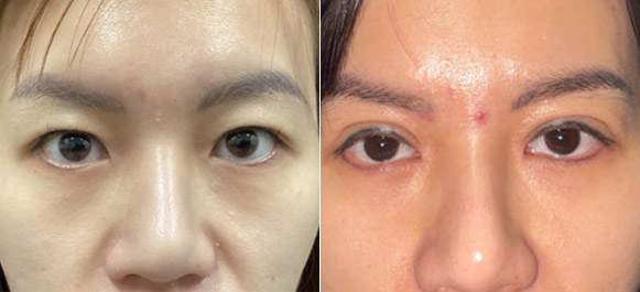 asian-eyelid-surgery
