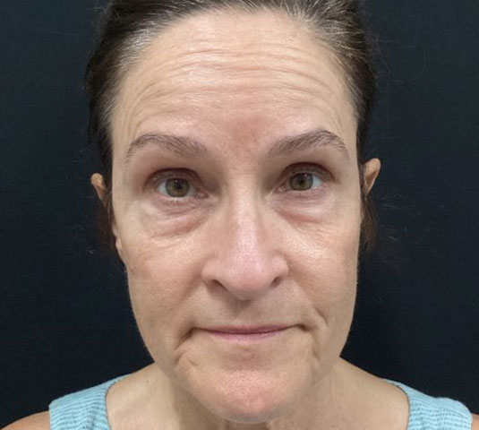 Before and After Lower Blepharoplasty and TCA chemical peel of the face