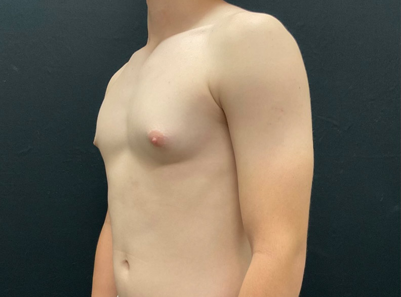 15 year old male shown 2 months after left gynecomastia excision.