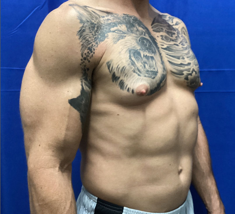 50-year-old 4 months after bilateral gynecomastia reduction