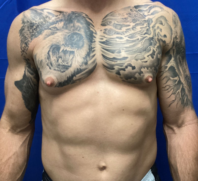 50-year-old 4 months after bilateral gynecomastia reduction