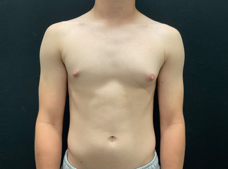 15 year old male shown 2 months after left gynecomastia excision.