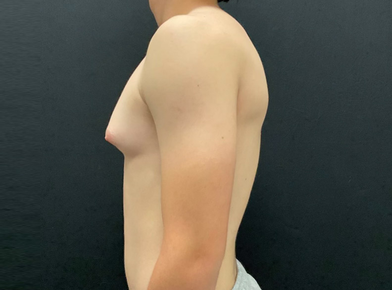 15 year old male shown 2 months after left gynecomastia excision.