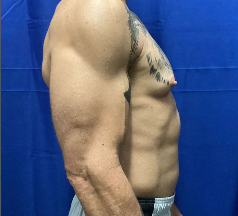 50-year-old 4 months after bilateral gynecomastia reduction
