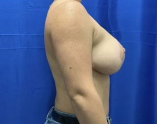 Breast lift before and after patient side view