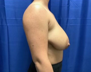 Breast lift before and after patient side view