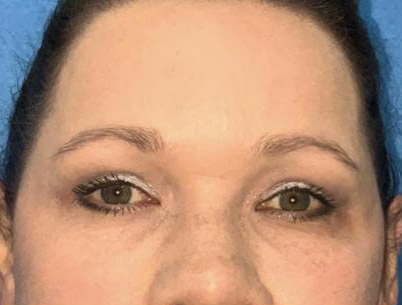 Upper and Lower Blepharoplasty before and after front view