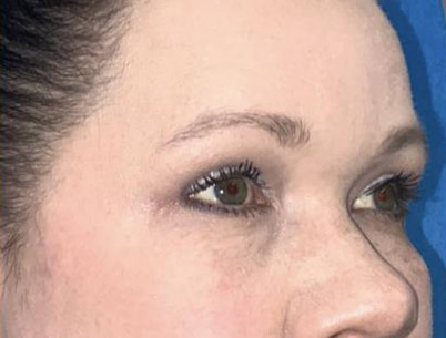 Upper and Lower Blepharoplasty before and after right view