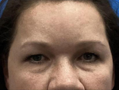 Upper and Lower Blepharoplasty before and after front view