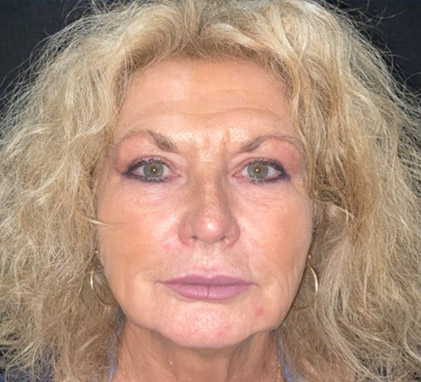 Botox and Filler Facial Recontouring After Image